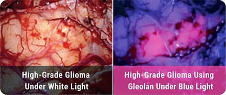 High-Grade Glioma under white light compared to High-Grade Glioma under blue light