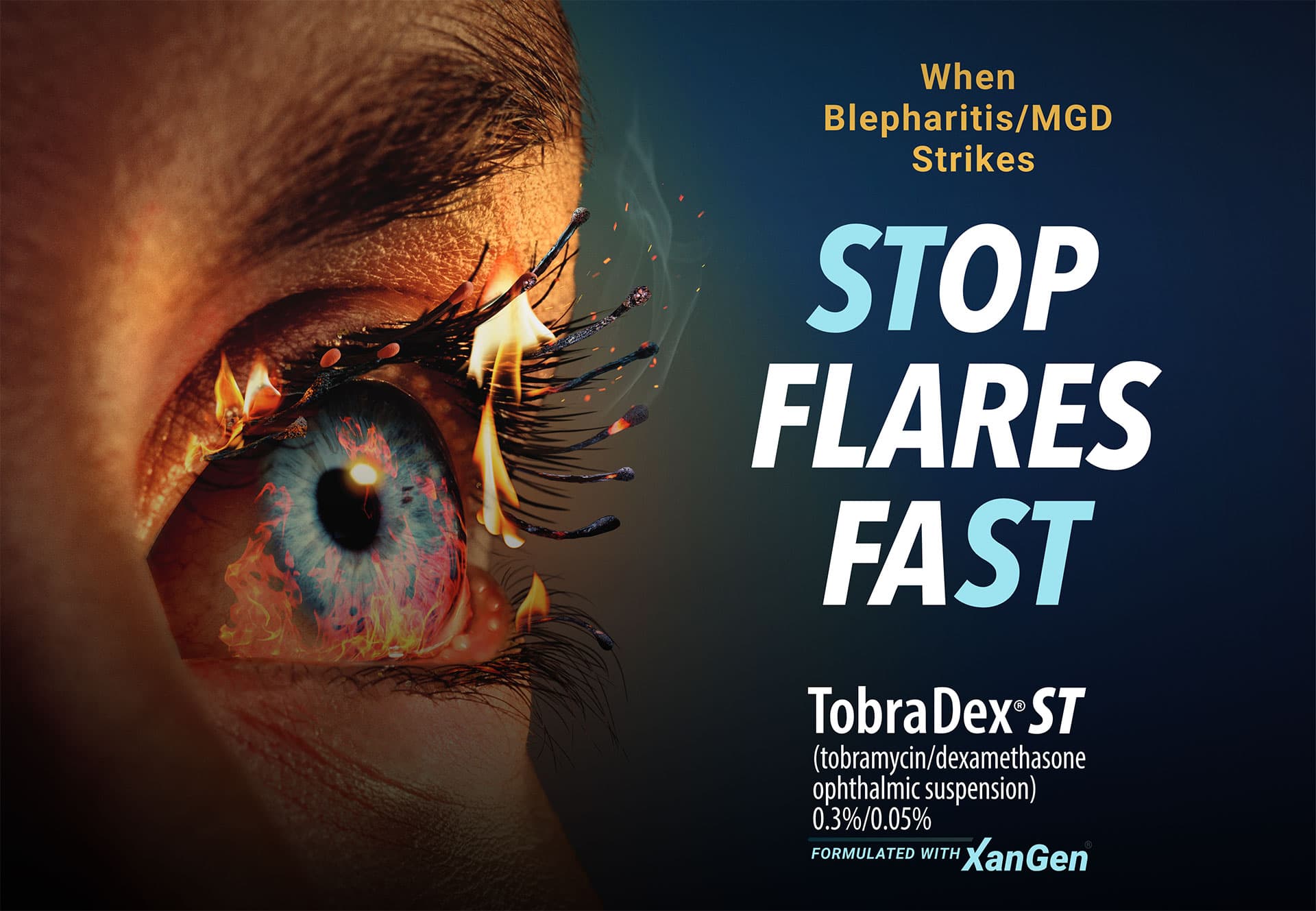 When blepharitis/MGD strikes stop flares fast TobradexST (tobramycin/dexamethasone ophthalmic suspension) 0.3%/0.05% formulated with XanGen